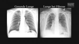 Elisabethinen: Lungenfibrose